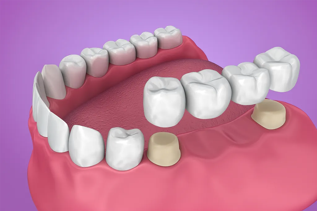 Teeth Restoration at ND Dental Care Laguna Hills